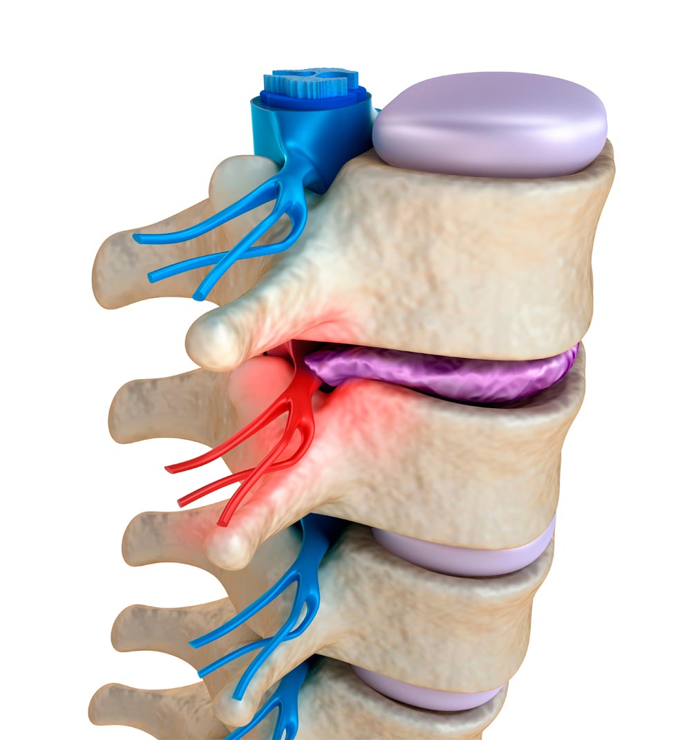 Pinched nerve in back
