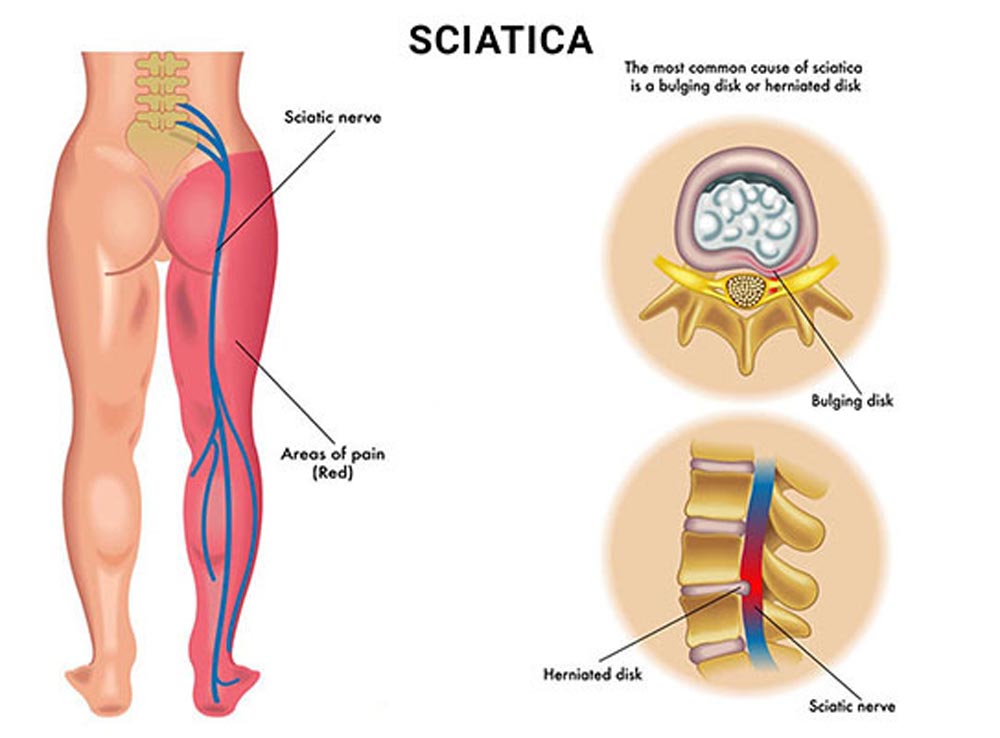 sciatica pain chart